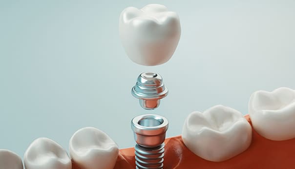 dental-implants-in-circle-pines-mn-lakeview-family-dentistry
