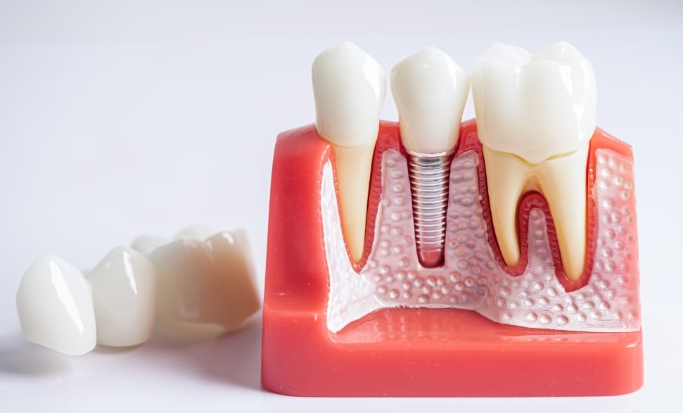 how dental implants improve oral health