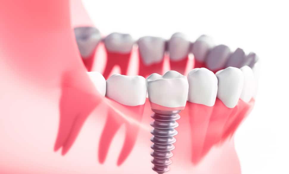 are all on X implants right for you