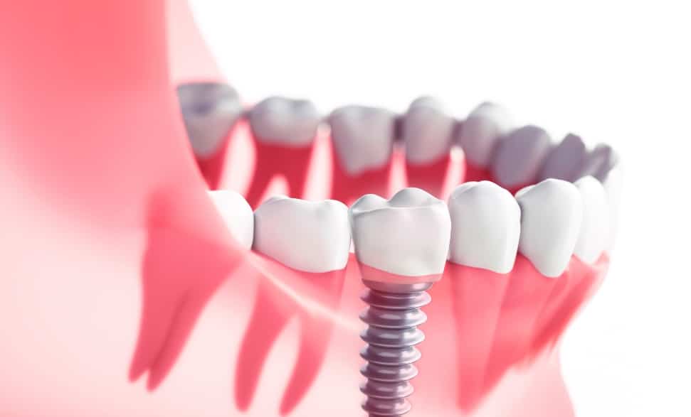 tips for maintaining implants