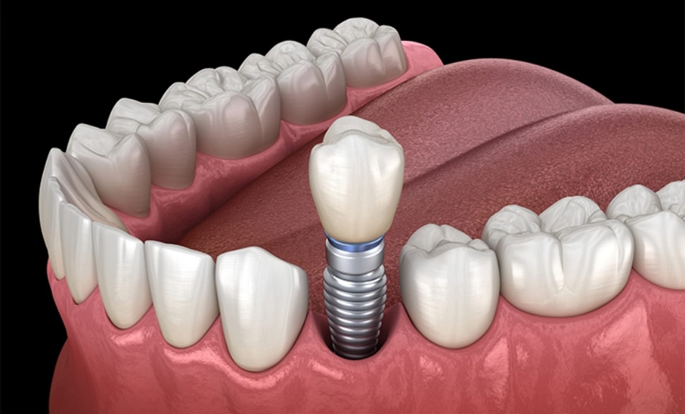 Missing Teeth Discover Why Dental Implants Are the Ultimate Long-Term Fix